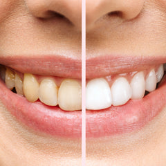 Denture Molds for Teeth (Top & Bottom) - Get Instant Veneers Smile & Confidence