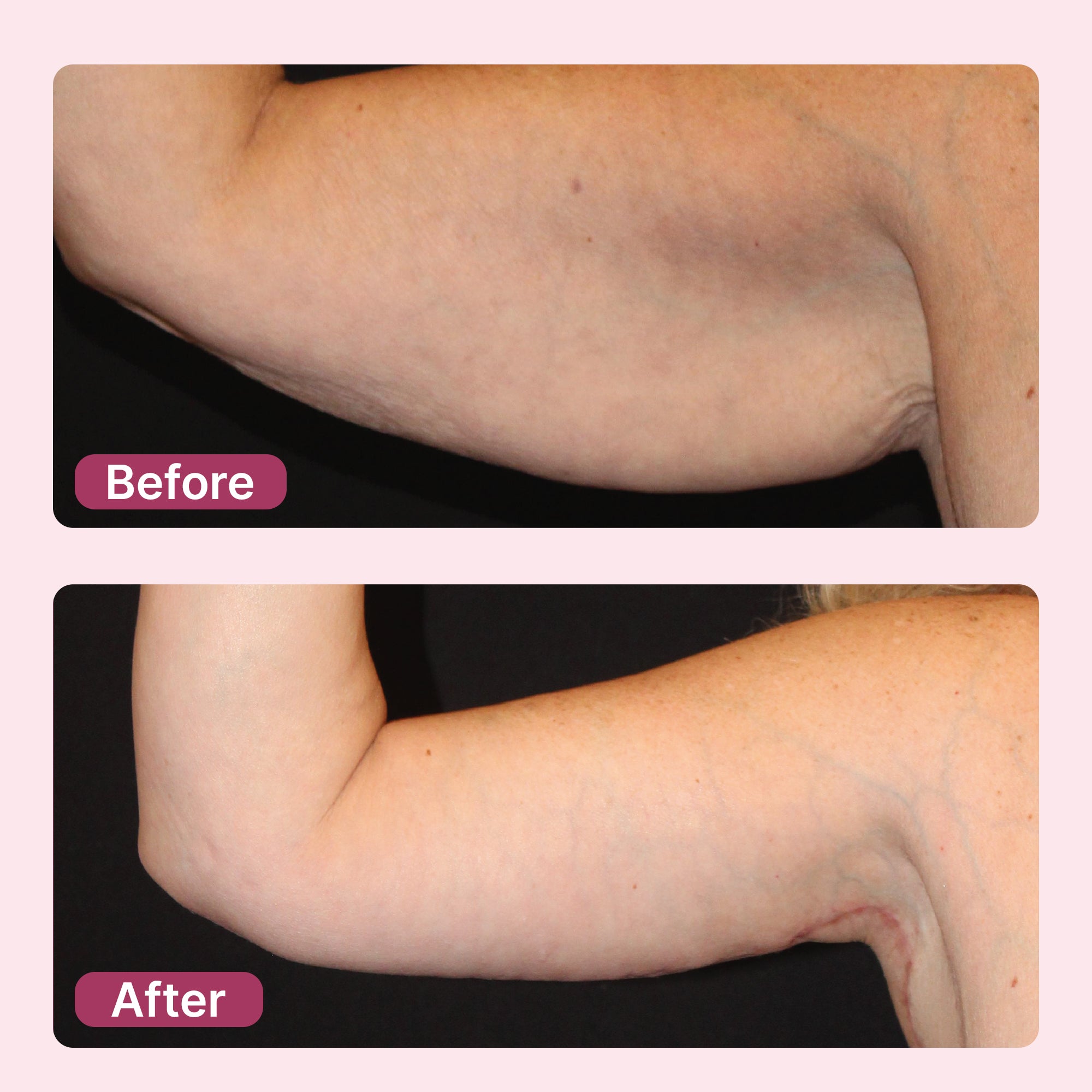 Ultrasonic Fat & Cellulite Burner