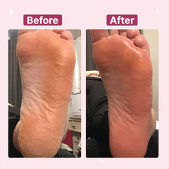 Electric Callus Foot Remover