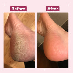 Electric Callus Foot Remover