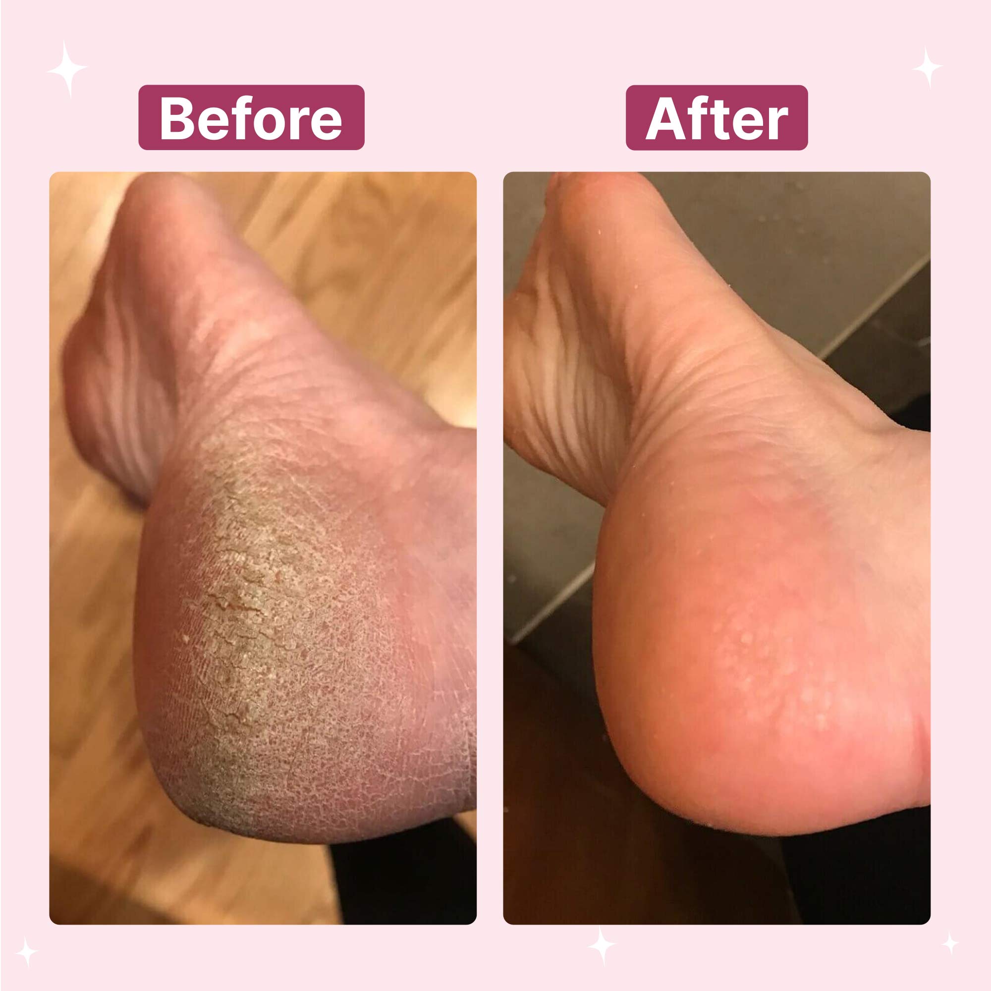 Electric Foot File Hard Skin Remover