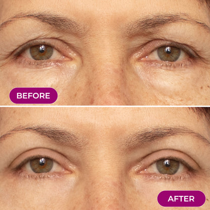 EMS Eye Red light Eye Massager - Reduce Wrinkles & Relax your eyes
